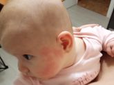 Аллергия на Джонсонс Бэби!