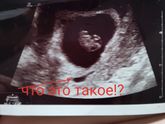 Что это такое?есть тут кто то кто шарит в узи?