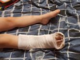Перелом😭