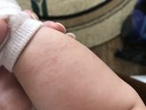 Сыпь с шершавостью