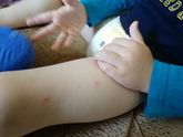 Появились сегодня такие прыщики