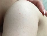 Потница или аллергия?