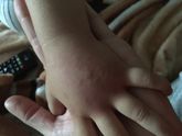 Кисть немного раздуло