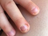 Дерматит у ребёнка чем лечите ?