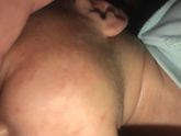 Аллергия или цветение?