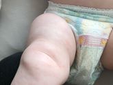 Аллергия?