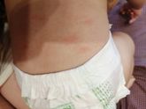 Подскажите это аллергия или