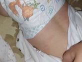 Девочки,вот ребенка появились пятна