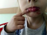 Упала дочка во сне в садике