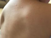 Потничка или аллергия ?
