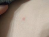 Как защититься от ветрянки?