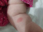 Чем помазать укусы от комаров