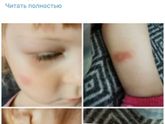 Прыщик или гематома?
