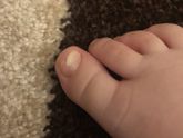 У ребёнка треснул ноготь
