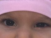 Разный размер/разрез глаз у ребенка