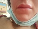 Кто делал губы. rejeunesse deep with lidocaine