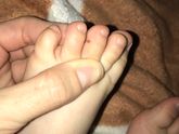 Девочки это родимое пятно ? Дочке 1.5