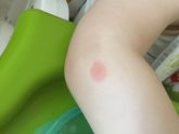 Высыпание у сына 2 года.