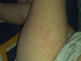 Сыпь у ребенка по