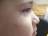 Это может быть реакция на укус?