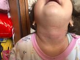 Сыпь у малышки где ключица и под шеей