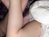Укусы или сыпь кто