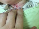 Красное пятно на шее