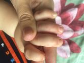Водянистые прищечки