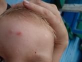 Укусы комаров или что то другое