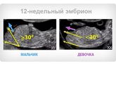 1 скрининг пол ребенка