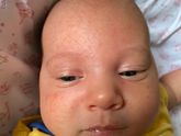 Сыпь на лице и шее 1 месяц