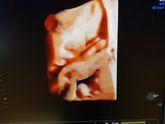 Третий скрининг. BABY# 2