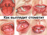 Кто, как лечит стоматит?