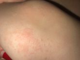 Подскажите это аллергия