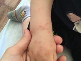 Прививка от кори и краснухи