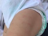 У малыша появились красные