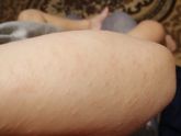 Односторонняя латероторакальная экзантема.