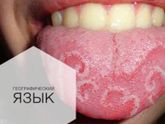 Такой язык у ребёнка ? (фото в коментах)