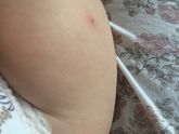 Реакция на прививку пентаксим!