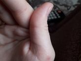 Прыщечки на руках