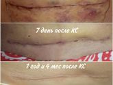 Шов от кесарева вздулся