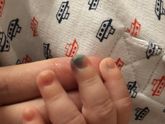 Девочки, воспалился заусенец, обрабатываю
