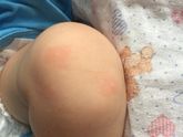 Красные пятна у грудничка