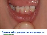 Желтеют зубы.