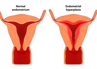 Симптомы и лечение гиперплазии эндометрия