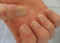 Деформация ногтей на руках: причины, лечение