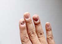 Причины и лечение волнистых ногтей на руках
