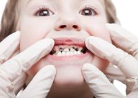 Причины и лечение белых пятен на зубах