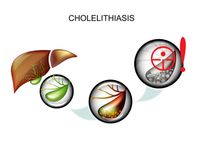 Клиника, диагностика и лечение хронического холецистита
