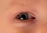 Причины, симптомы и лечение красных глаз у детей